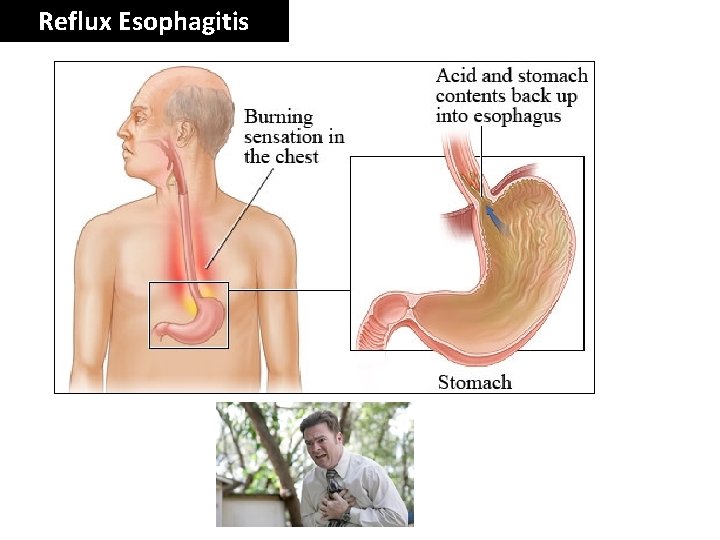 Reflux Esophagitis 