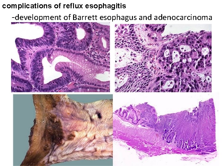 complications of reflux esophagitis -development of Barrett esophagus and adenocarcinoma 