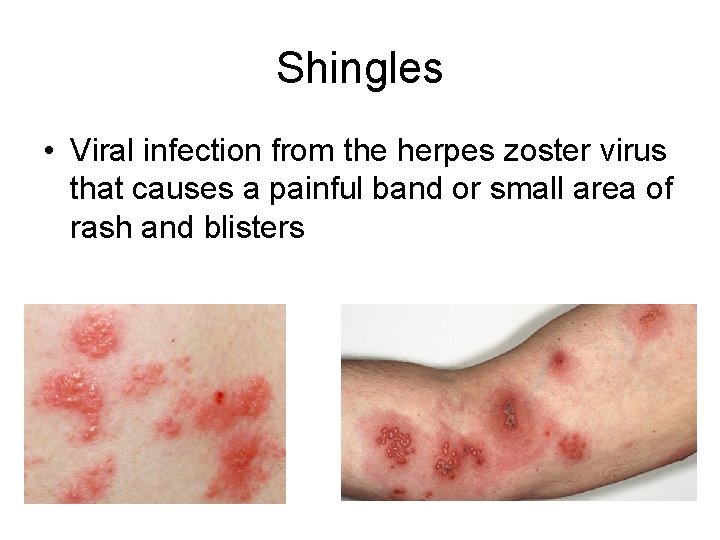 Shingles • Viral infection from the herpes zoster virus that causes a painful band