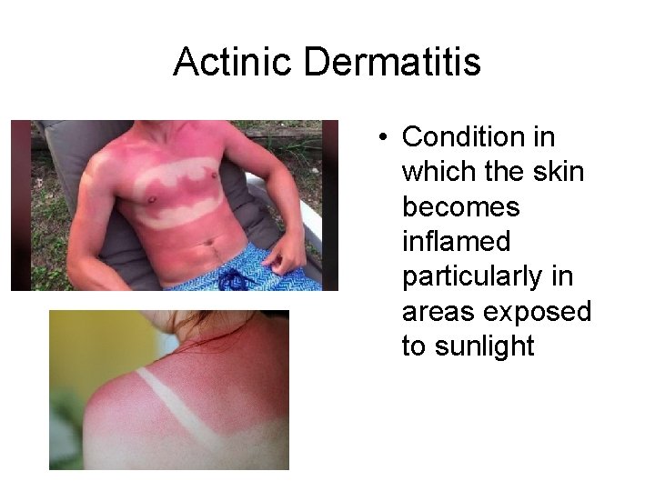 Actinic Dermatitis • Condition in which the skin becomes inflamed particularly in areas exposed