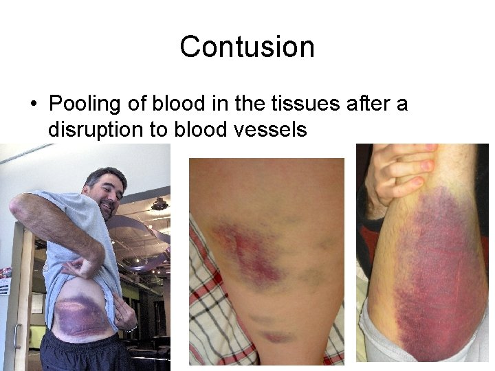 Contusion • Pooling of blood in the tissues after a disruption to blood vessels