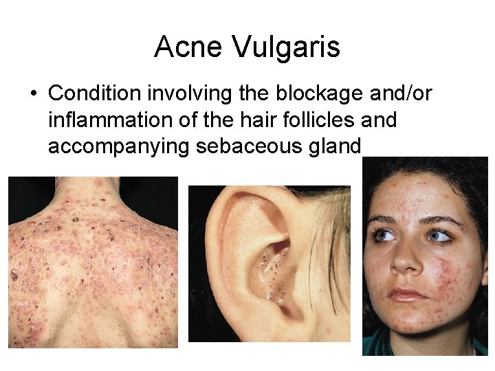 Acne Vulgaris • Condition involving the blockage and/or inflammation of the hair follicles and