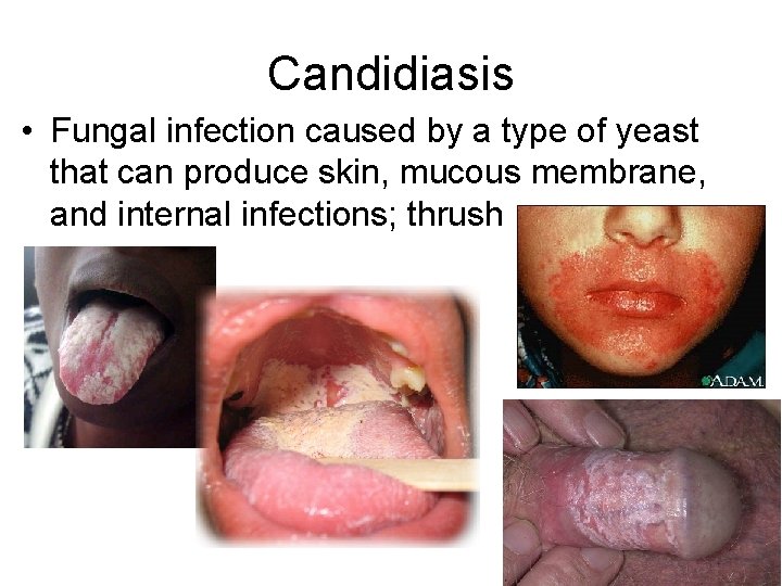 Candidiasis • Fungal infection caused by a type of yeast that can produce skin,