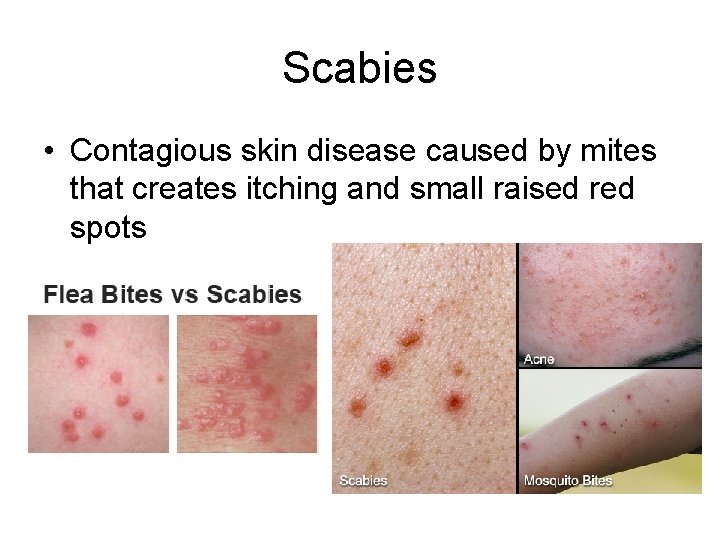 Scabies • Contagious skin disease caused by mites that creates itching and small raised