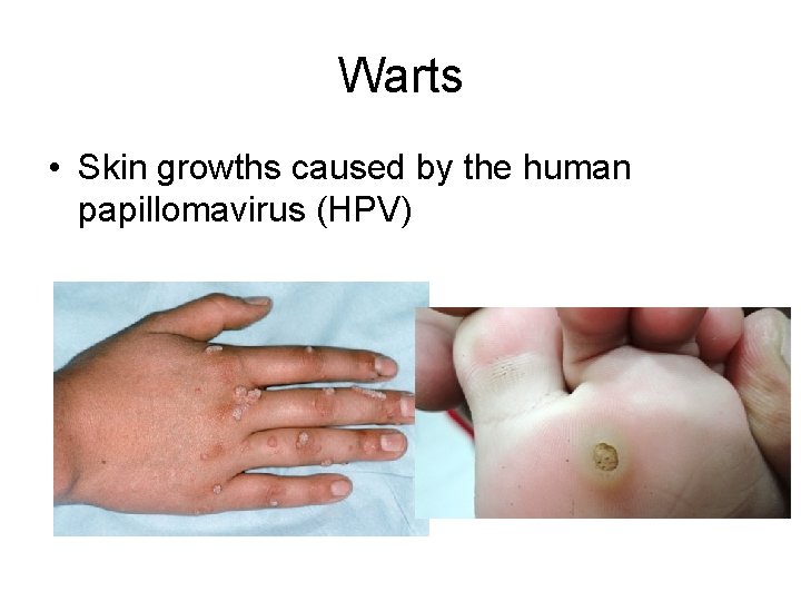 Warts • Skin growths caused by the human papillomavirus (HPV) 
