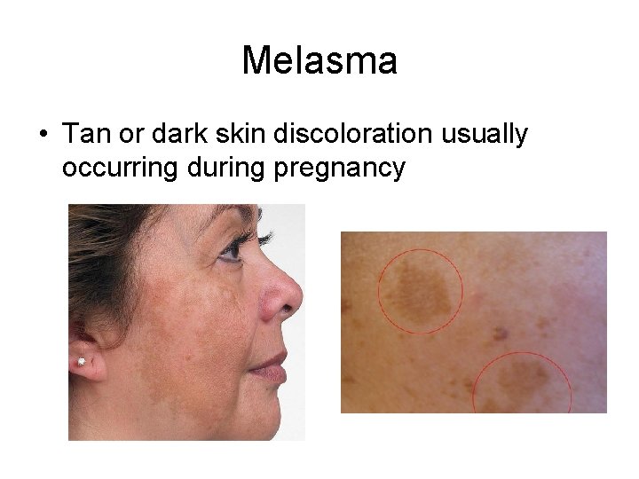 Melasma • Tan or dark skin discoloration usually occurring during pregnancy 