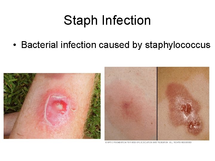 Staph Infection • Bacterial infection caused by staphylococcus 