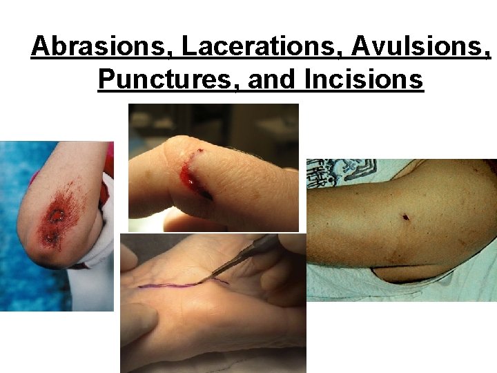 Abrasions, Lacerations, Avulsions, Punctures, and Incisions 