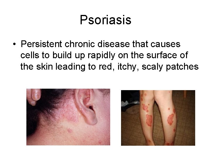 Psoriasis • Persistent chronic disease that causes cells to build up rapidly on the