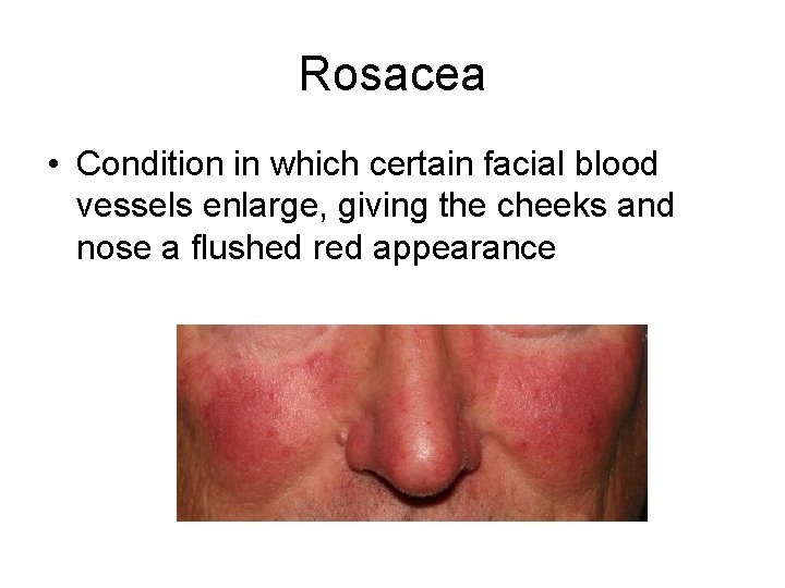 Rosacea • Condition in which certain facial blood vessels enlarge, giving the cheeks and