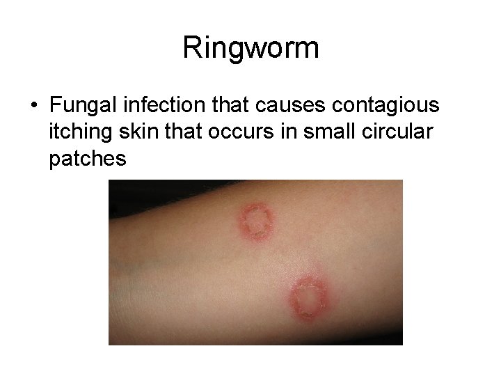 Ringworm • Fungal infection that causes contagious itching skin that occurs in small circular
