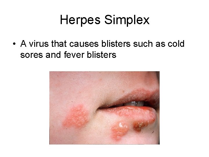 Herpes Simplex • A virus that causes blisters such as cold sores and fever