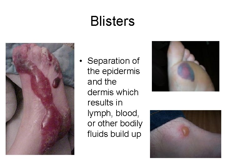 Blisters • Separation of the epidermis and the dermis which results in lymph, blood,