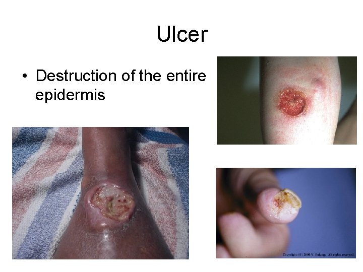 Ulcer • Destruction of the entire epidermis 