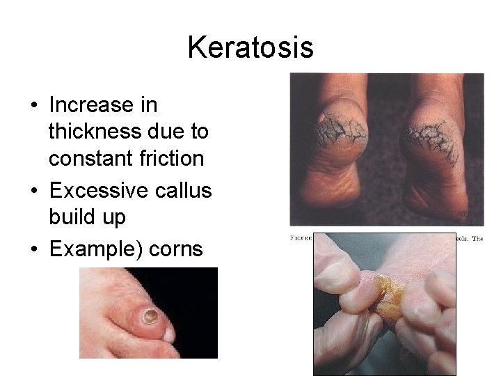 Keratosis • Increase in thickness due to constant friction • Excessive callus build up