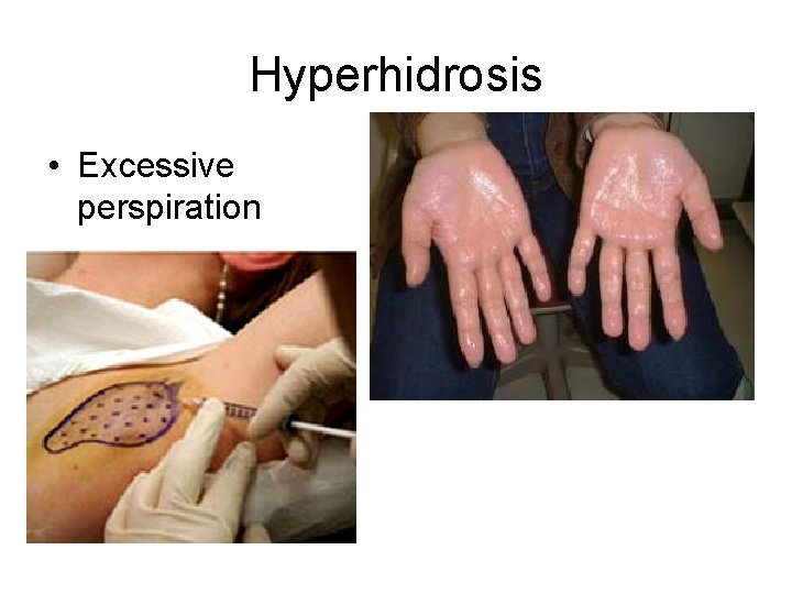 Hyperhidrosis • Excessive perspiration 