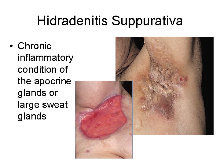 Hidradenitis Suppurativa • Chronic inflammatory condition of the apocrine glands or large sweat glands
