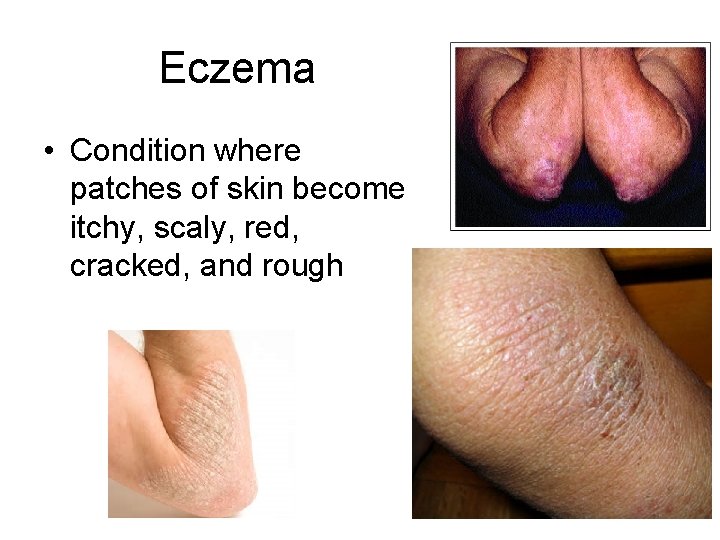 Eczema • Condition where patches of skin become itchy, scaly, red, cracked, and rough