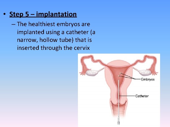  • Step 5 – implantation – The healthiest embryos are implanted using a