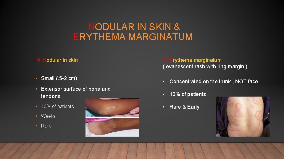 NODULAR IN SKIN & ERYTHEMA MARGINATUM v Nodular in skin • Small (. 5