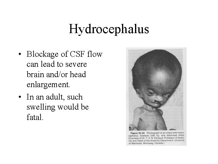 Hydrocephalus • Blockage of CSF flow can lead to severe brain and/or head enlargement.