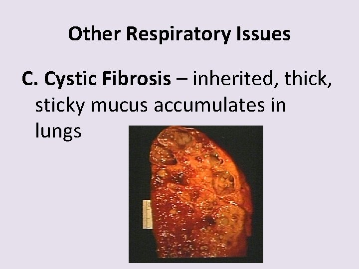 Other Respiratory Issues C. Cystic Fibrosis – inherited, thick, sticky mucus accumulates in lungs
