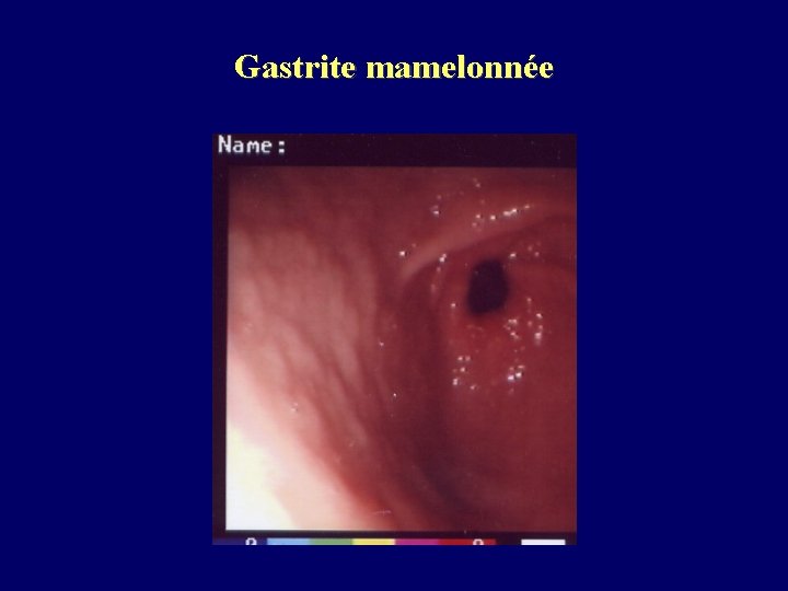 Gastrite mamelonnée 