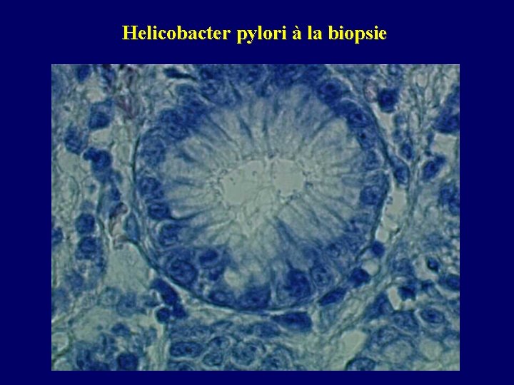 Helicobacter pylori à la biopsie 