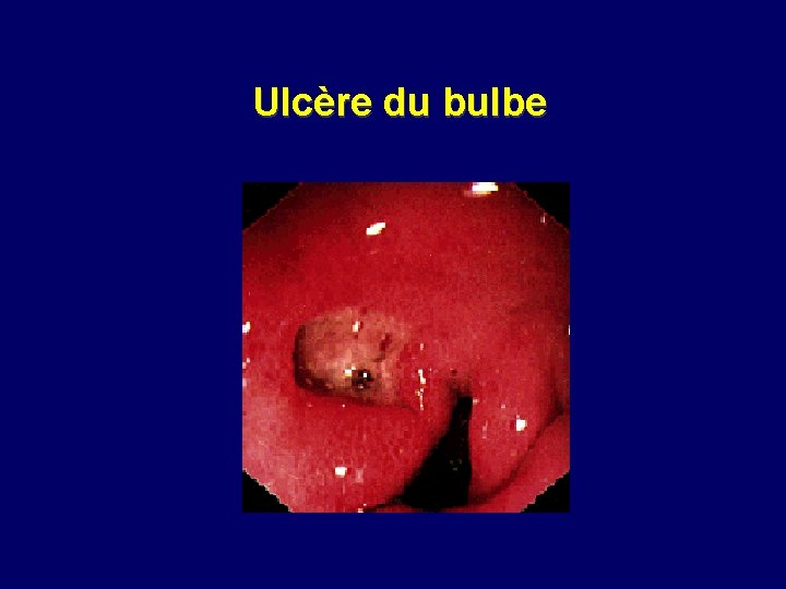 Ulcère du bulbe 