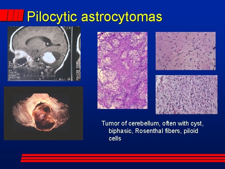 Pilocytic astrocytomas Tumor of cerebellum, often with cyst, biphasic, Rosenthal fibers, piloid cells 