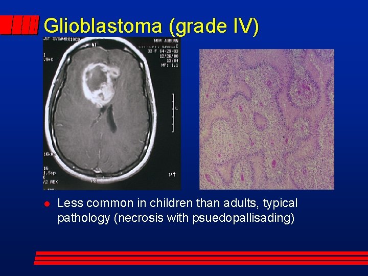 Glioblastoma (grade IV) Less common in children than adults, typical pathology (necrosis with psuedopallisading)