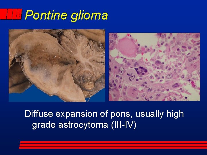 Pontine glioma Diffuse expansion of pons, usually high grade astrocytoma (III-IV) 