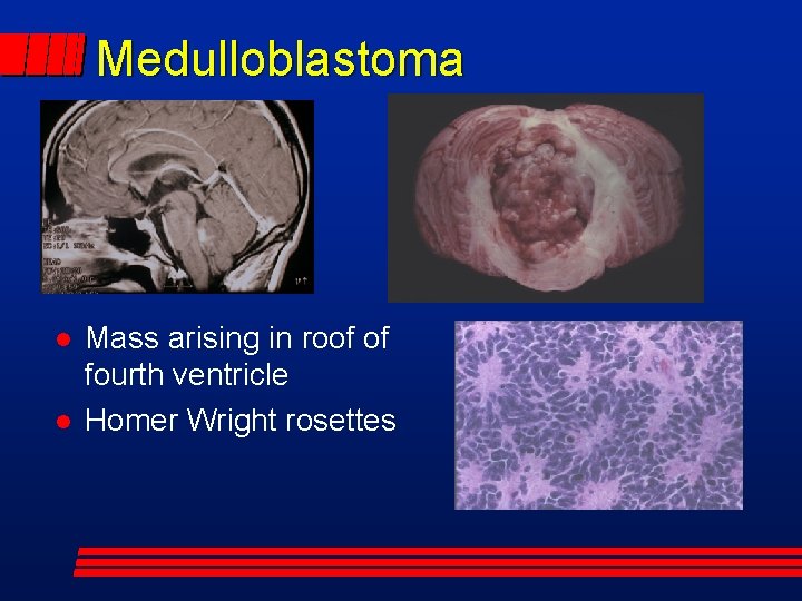 Medulloblastoma Mass arising in roof of fourth ventricle Homer Wright rosettes 