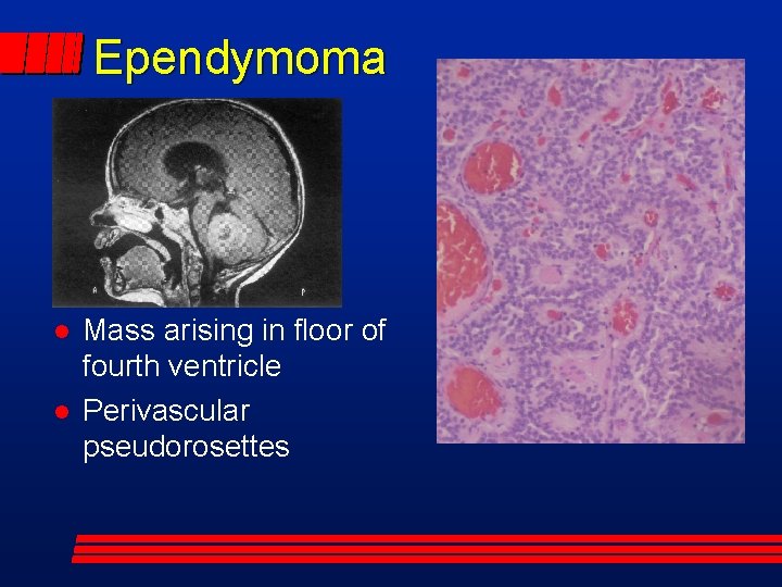Ependymoma Mass arising in floor of fourth ventricle Perivascular pseudorosettes 
