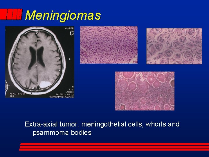 Meningiomas Extra-axial tumor, meningothelial cells, whorls and psammoma bodies 