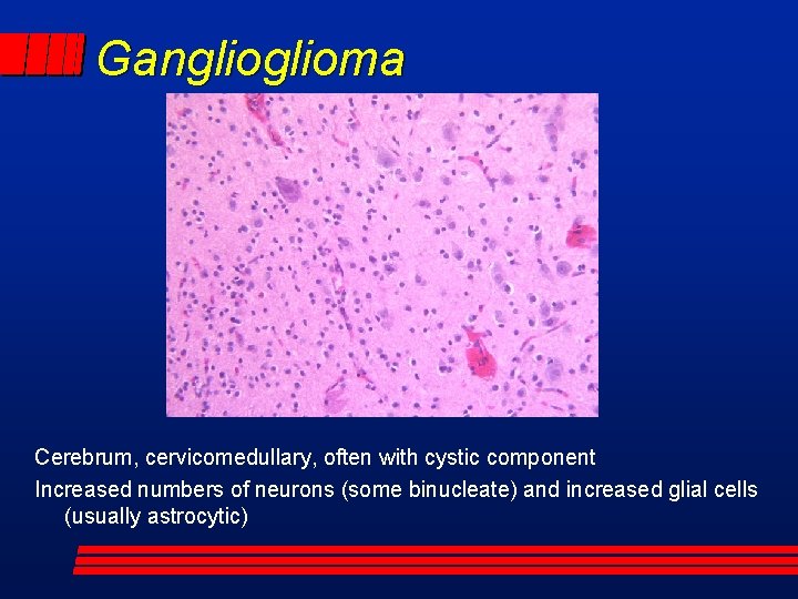 Ganglioma Cerebrum, cervicomedullary, often with cystic component Increased numbers of neurons (some binucleate) and