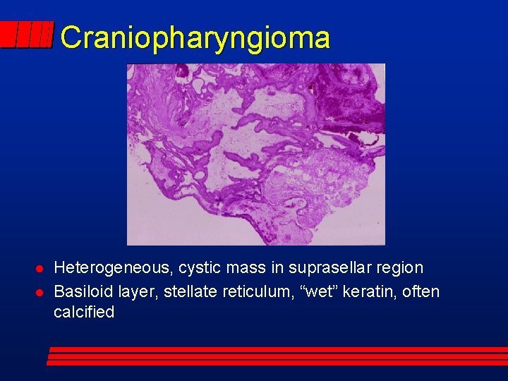 Craniopharyngioma Heterogeneous, cystic mass in suprasellar region Basiloid layer, stellate reticulum, “wet” keratin, often