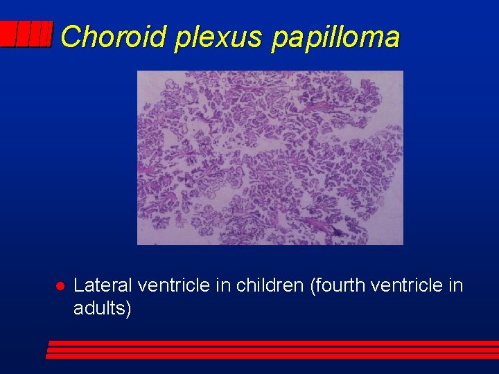 Choroid plexus papilloma Lateral ventricle in children (fourth ventricle in adults) 