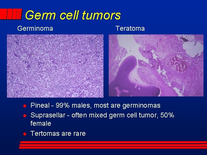Germ cell tumors Germinoma Teratoma Pineal - 99% males, most are germinomas Suprasellar -