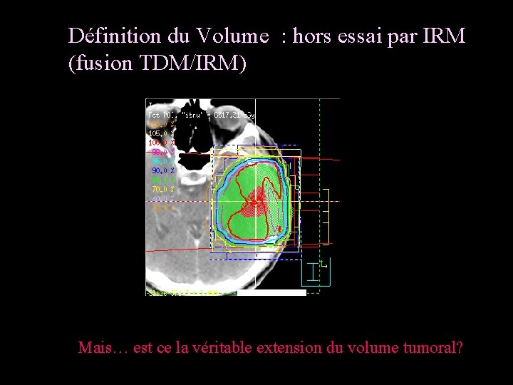 Définition du Volume : hors essai par IRM (fusion TDM/IRM) Mais… est ce la