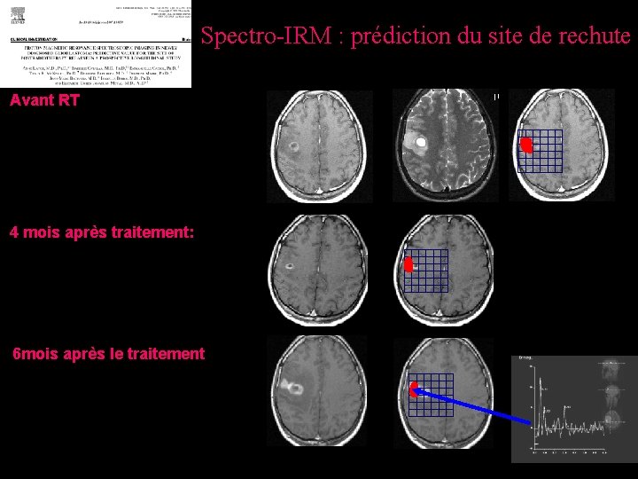 Spectro-IRM : prédiction du site de rechute Avant RT 4 mois après traitement: 6