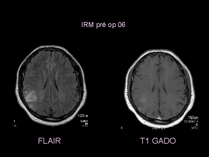 IRM pré op 06 FLAIR T 1 GADO 