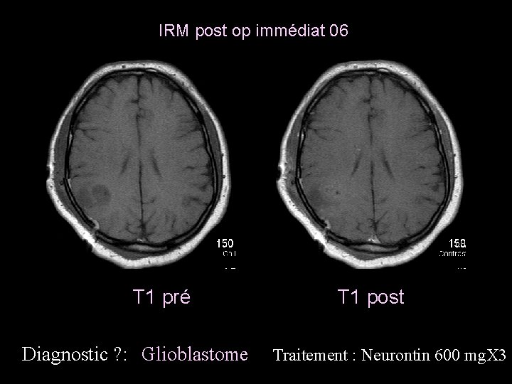 IRM post op immédiat 06 T 1 pré Diagnostic ? : Glioblastome T 1