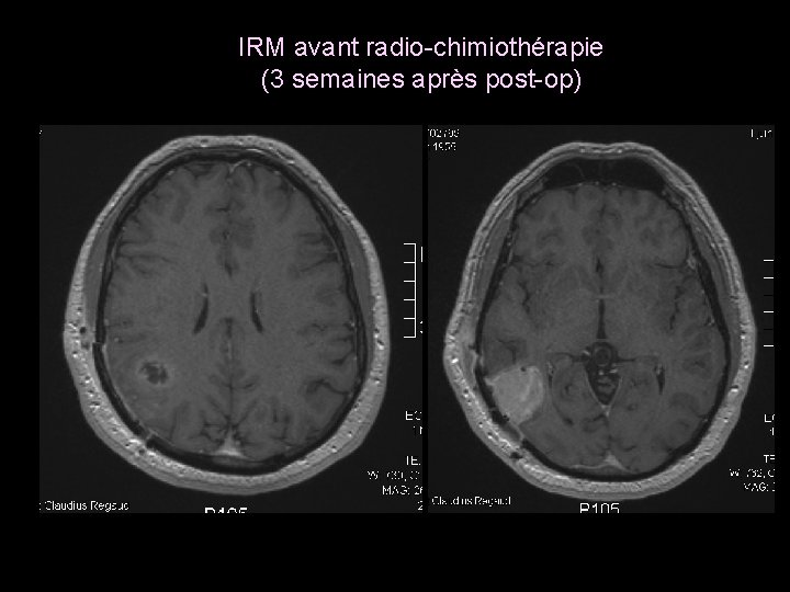 IRM avant radio-chimiothérapie (3 semaines après post-op) 