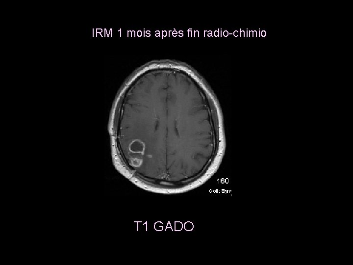IRM 1 mois après fin radio-chimio T 1 GADO 