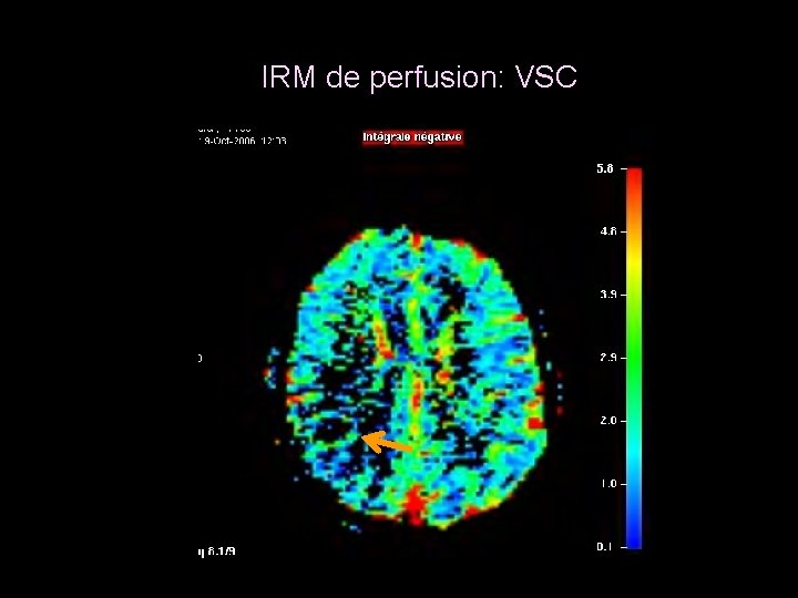 IRM de perfusion: VSC 