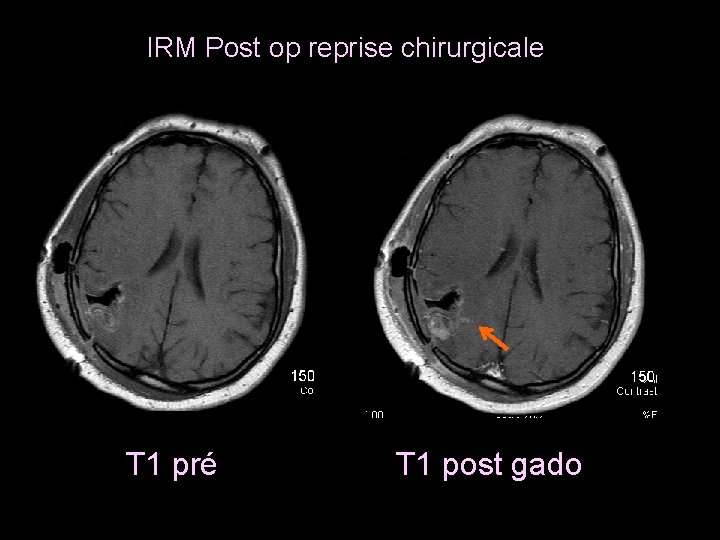 IRM Post op reprise chirurgicale T 1 pré T 1 post gado 