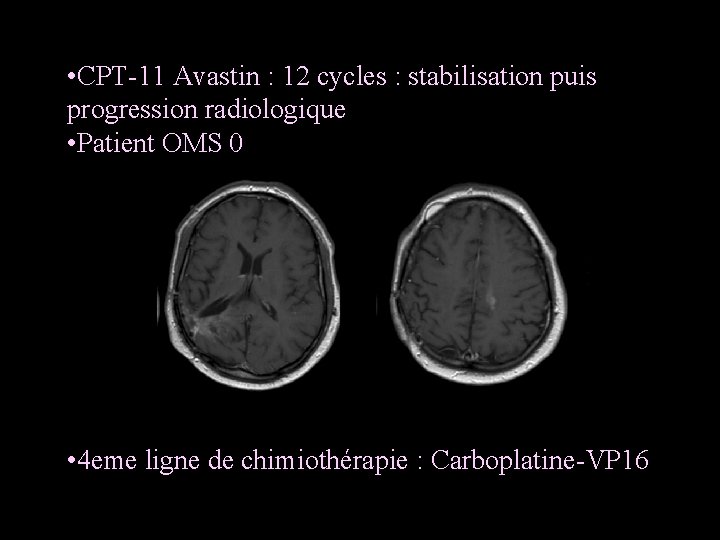  • CPT-11 Avastin : 12 cycles : stabilisation puis progression radiologique • Patient