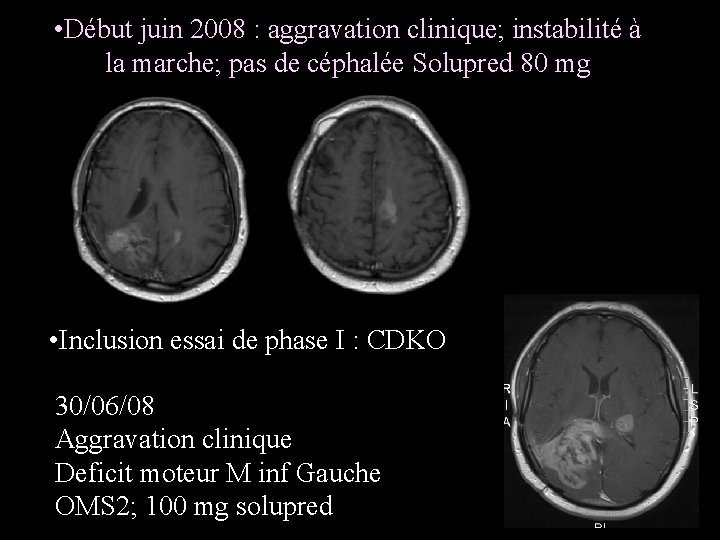  • Début juin 2008 : aggravation clinique; instabilité à la marche; pas de