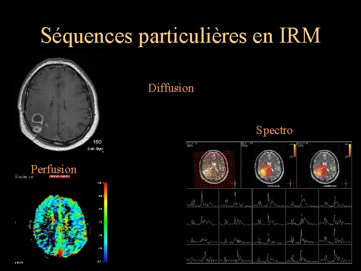 Séquences particulières en IRM Diffusion Spectro Perfusion 